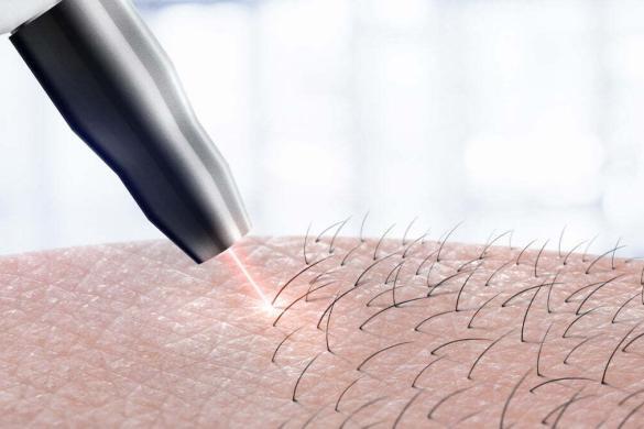 cosmetology procedure laser hair removal on body parts. Laser epilation.